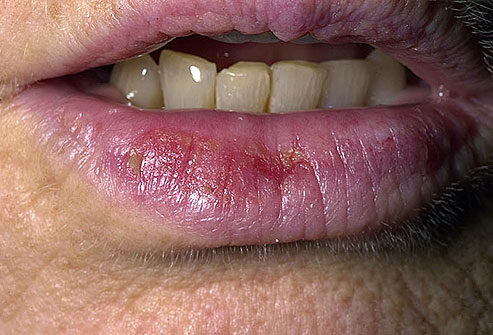 Cure Angular Cheilities Now How To Treat Angular Cheilitis Curing Angular Cheilitis