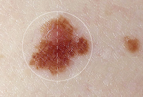 skin asymmetry mole cancer moles know cancers normal freckles does asymmetrical sides match line